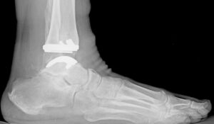 Ankle Replacements – Malleshwara Orthopaedic Centre And Polyclinic