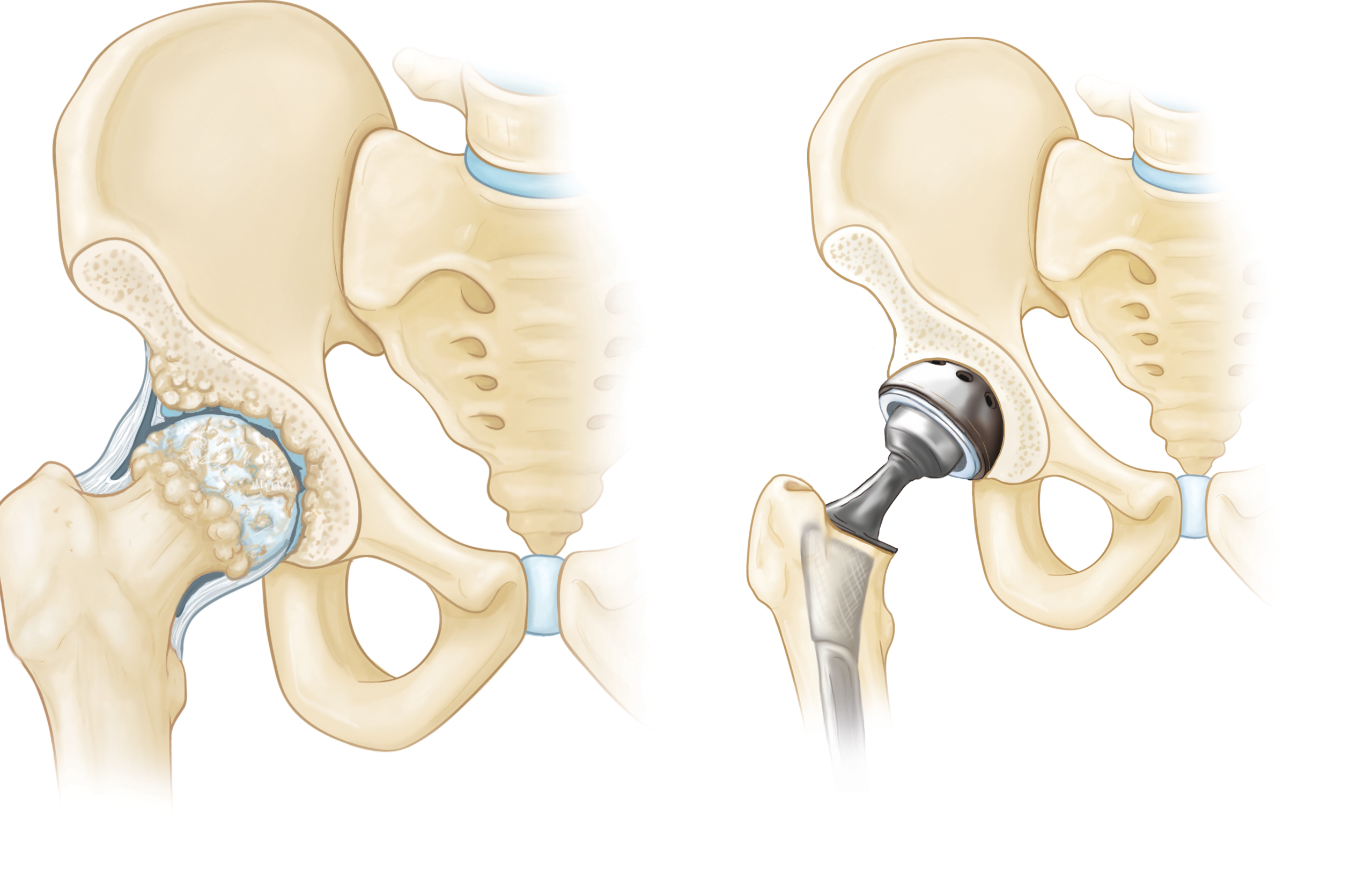 Hip Replacement Malleshwara Orthopaedic Centre and Polyclinic